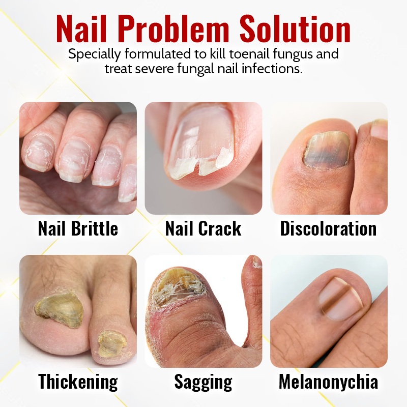 Japanese NailRenew Onychomycosis Rapid Relief Oil