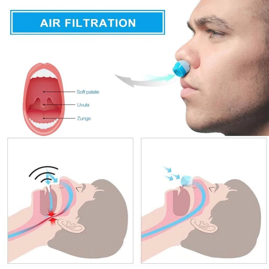 Airing: The first hoseless, maskless, micro-CPAP Anti Snoring