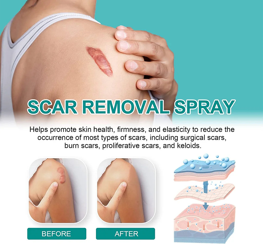 ADVANCED SCAR SPRAY FOR ALL TYPES OF SCARS - FOR EXAMPLE ACNE SCARS, SURGICAL SCARS AND STRETCH MARKS