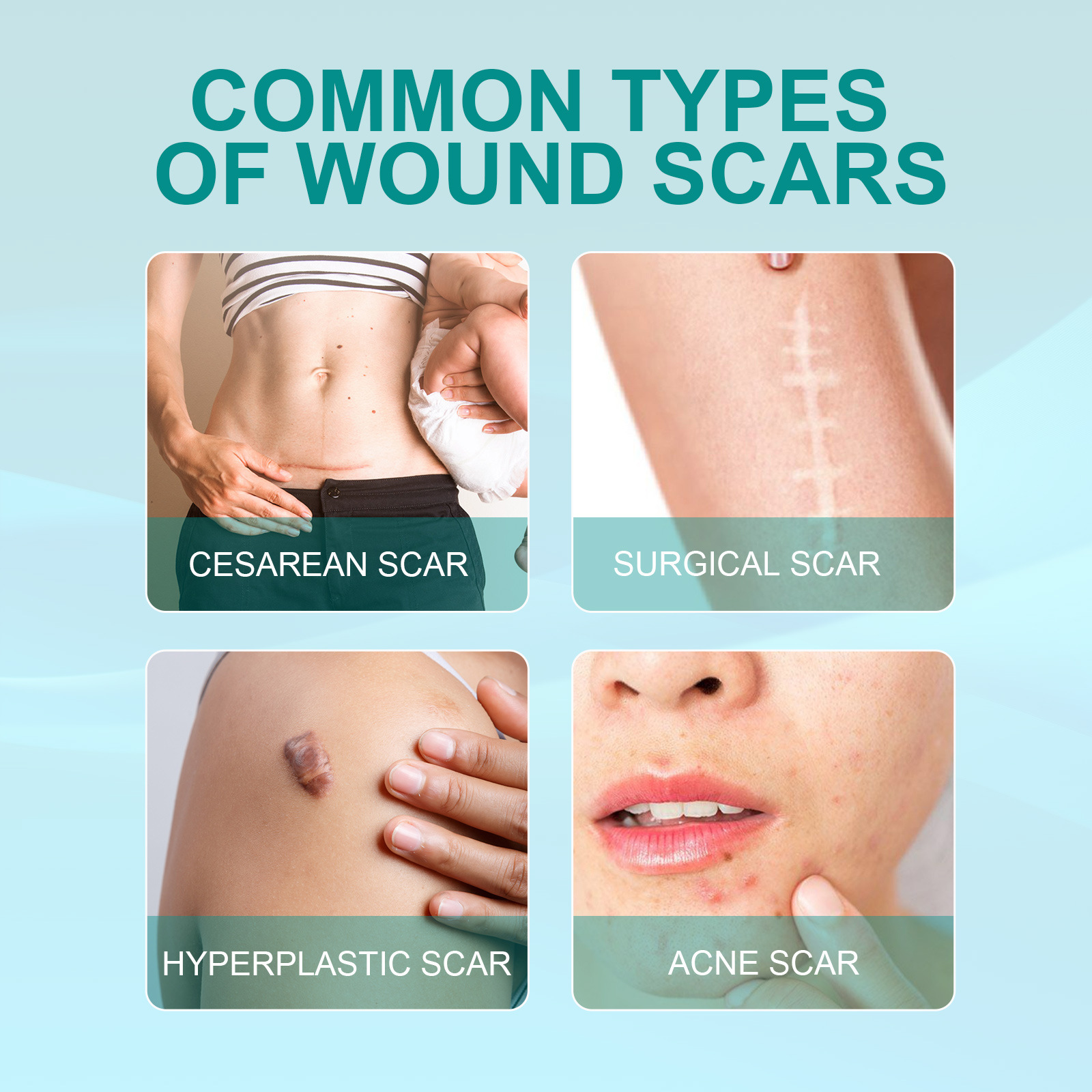 ADVANCED SCAR SPRAY FOR ALL TYPES OF SCARS – FOR EXAMPLE ACNE SCARS, SURGICAL SCARS AND STRETCH MARKS