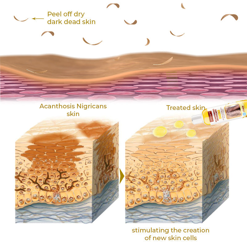 GFOUK Acanthosis Nigricans Peeling Oil