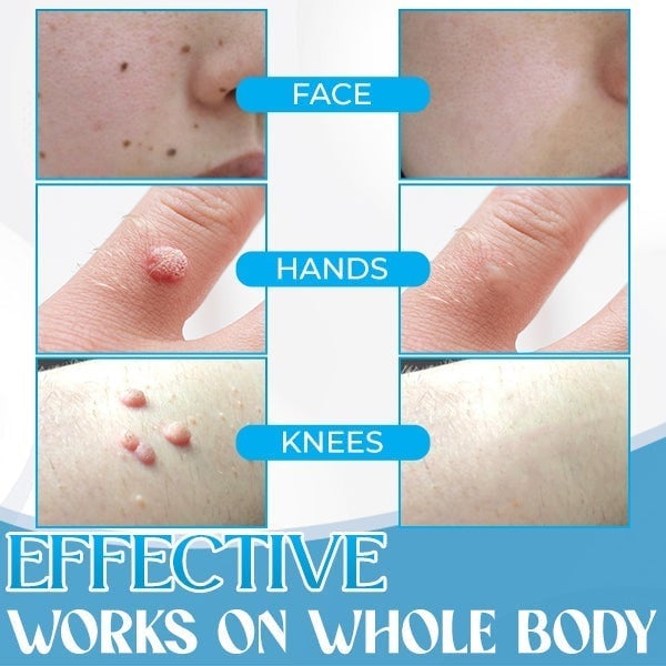 Auto Micro Skin Tag Remover