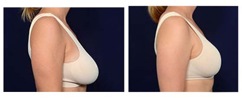 Breast Enhancement Patch