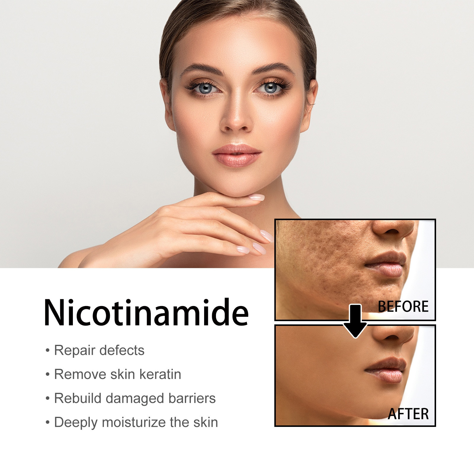 Buy 1 Get 1 Free – Niacinamide Spot Correcting Anti-Acne Serum