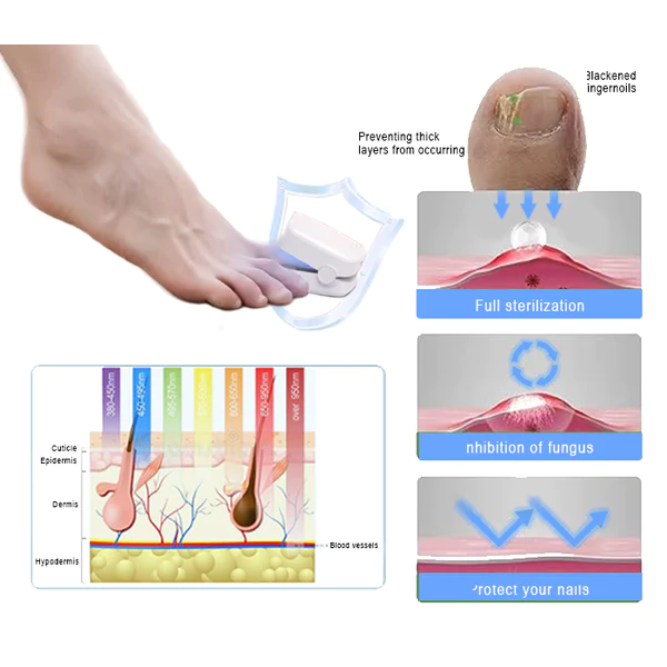 Oveallgo ProX Revolutionary High-Efficiency Light Therapy Device For Toenail Diseases